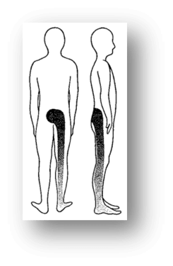 sciatica-mckenzie sciatica-mckenzie
